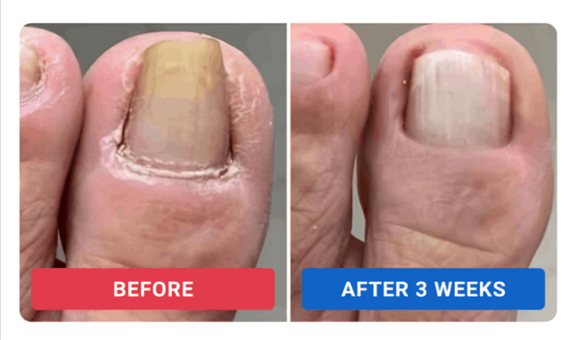 Orevelle Nail Fungus Pen review by Dan R. – Orevelle