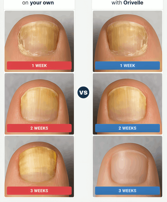 Orevelle Nail Fungus Pen before and after – Orevelle